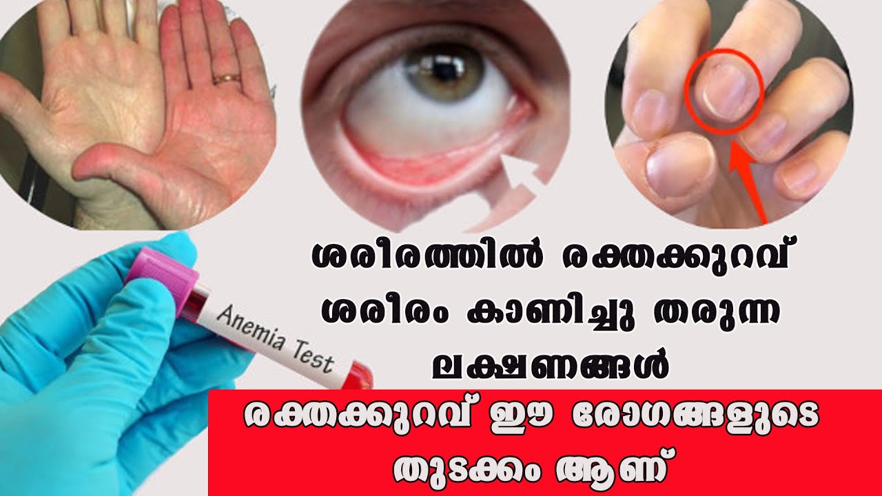 ശരീരത്തിലെ രക്തക്കുറവ് ഇല്ലാതാക്കാൻ ഇക്കാര്യങ്ങൾ ശ്രദ്ധിക്കുക