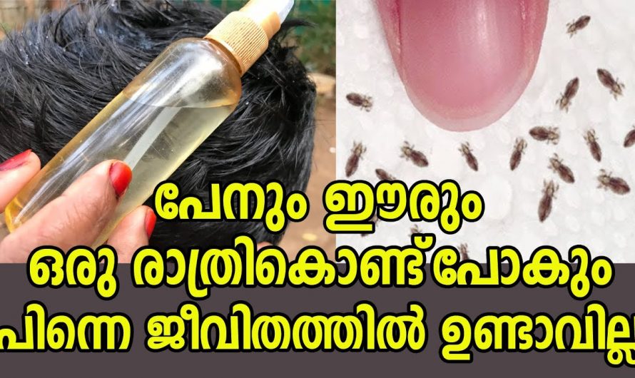 ഈരും പേനും കാരണം നിങ്ങൾ അസ്വസ്ഥരാകുന്നുണ്ടോ, ഒരു രാത്രി മതി ഇവയെല്ലാം ഇല്ലാതാക്കാൻ.