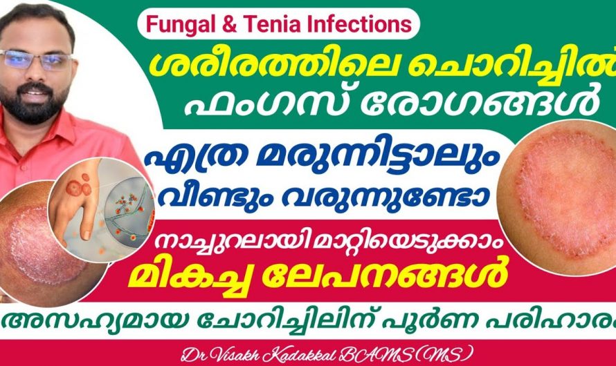 ശരീരത്തിന്റെ പലഭാഗത്തും ഉണ്ടാകുന്ന ചൊറിച്ചിൽ നാച്ചുറലായി മാറ്റിയെടുക്കാം.