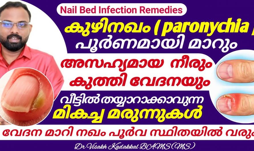 നഖങ്ങൾക്കിടയിൽ പഴുപ്പ് കയറുന്നുണ്ടോ. നഖങ്ങൾ കുത്തി വേദനിക്കുന്നുണ്ടോ.