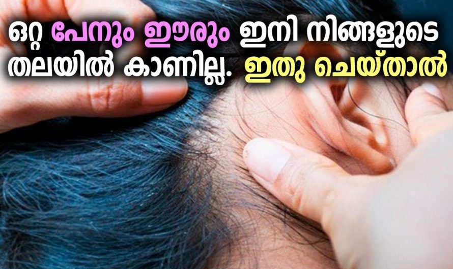 പേനും ഈരും പോയ വഴി പോലും കാണില്ല. തല മാന്തി മടുത്തവരാണോ എങ്കിൽ ഇത് ചെയ്യൂ.