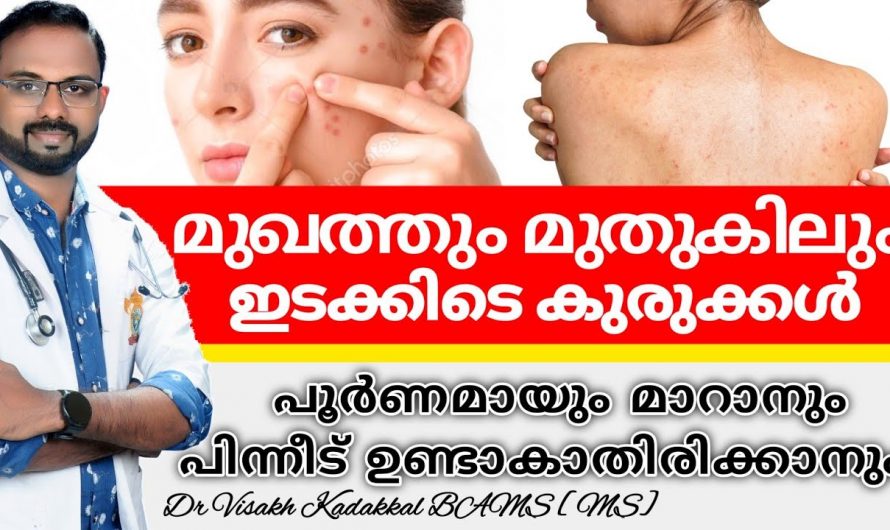 ഓയിലി സ്കിന്ന് ആണോ മുഖത്ത് ഇടയ്ക്കിടെ കുരുക്കൾ ഉണ്ടാകുന്നുണ്ടോ എങ്കിൽ നിങ്ങൾക്കൊരു പരിഹാരം ഇതാ.