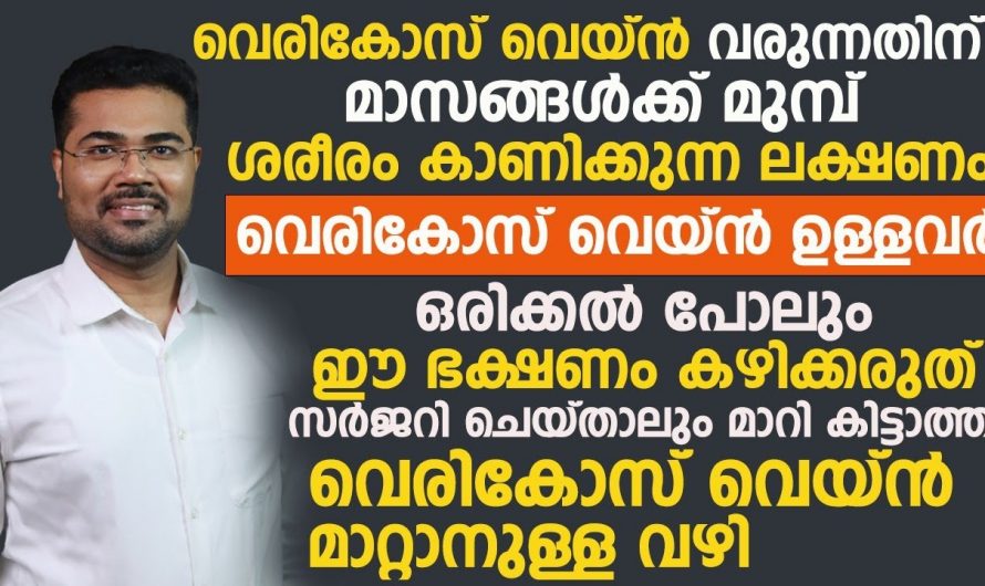 ഇനി വെരിക്കോസ് പ്രശ്നങ്ങളെ പരിഹരിക്കാൻ ഒരു സർജറിയും വേണ്ട. വെരിക്കോസ്, ശരീരം കാണിക്കുന്ന ചില പ്രധാന ലക്ഷണങ്ങൾ.