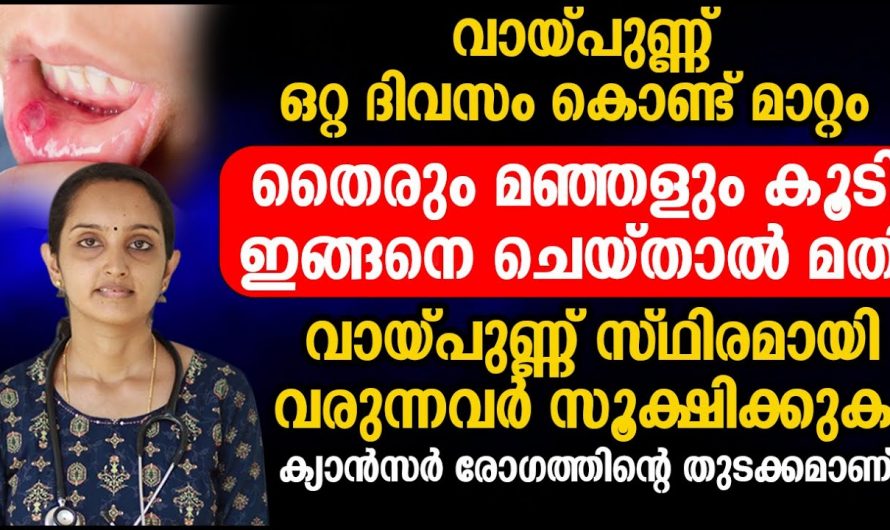 നിസംശയം മാറ്റിയെടുക്കാം വായ്പുണ്ണും അനുബന്ധ പ്രശ്നങ്ങളും