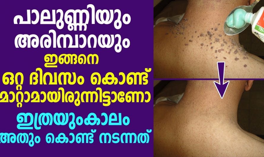 രാത്രി ഉറക്കത്തിന് മുൻപ് ഒരു 10 മിനിറ്റ് ശ്രദ്ധിച്ചാൽ അരിമ്പാറ ഇല്ലാതാക്കാം