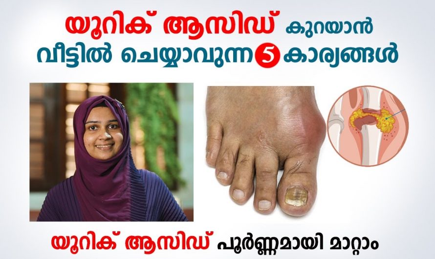 ഇത് പിന്തുടർന്നാൽ യൂറിക്കാസിഡ് ഈസിയായി നിയന്ത്രിക്കാം