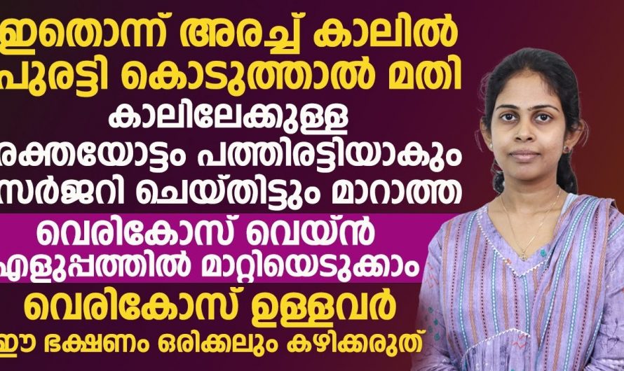 ഓപ്പറേഷനിലൂടെ പോലും മാറാത്ത വെരിക്കോസ് ഇത് ചെയ്താൽ മാറും