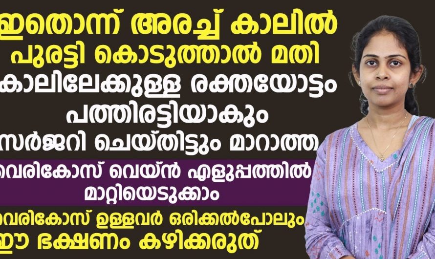 വെരിക്കോസ് മൂലം പ്രയാസപ്പെടുന്നവർ സർജറിക്കു മുൻപ് ഇതൊന്നു ചെയ്തു നോക്കൂ