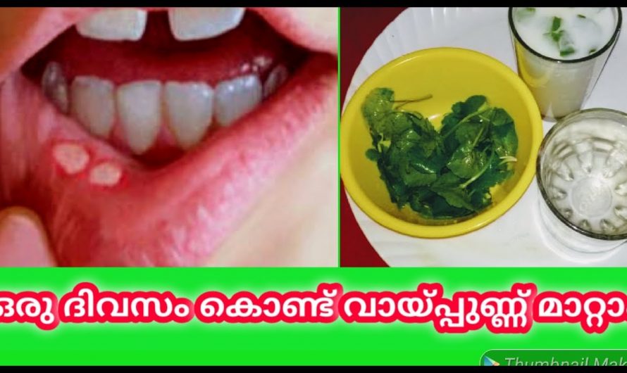 പാടു പോലും അവശേഷിക്കാതെ വായ്പുണ്ണ് മാറാൻ ഇനി ഇങ്ങനെ ചെയ്യാം